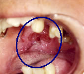 やや進行した咽頭癌