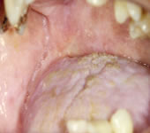 放射線、抗癌剤治療後